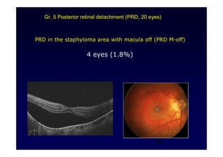 20
PRD in the staphyloma area with macula off (PRD M-off)
4 eyes (1.8%)
Gr. 5 Posterior retinal detachment (PRD, 20 eyes)
 