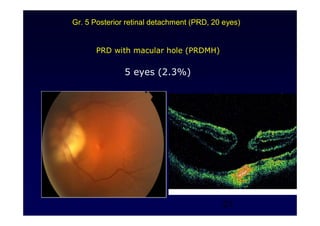 21
PRD with macular hole (PRDMH)
5 eyes (2.3%)
Gr. 5 Posterior retinal detachment (PRD, 20 eyes)
 