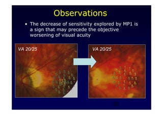 26
Observations
• The decrease of sensitivity explored by MP1 is
a sign that may precede the objective
worsening of visual acuity
VA 20/25 VA 20/25
 