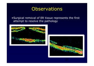 27
•Surgical removal of ER tissue represents the first
attempt to resolve the pathology
Observations
 
