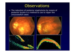 28
• The reduction of posterior staphyloma by means of
posterior buckle is a method to use to repair the
unsuccessfull cases
Observations
 