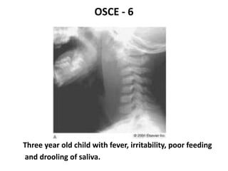 OSCE - 6
Three year old child with fever, irritability, poor feeding
and drooling of saliva.
 