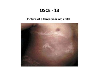OSCE - 13
Picture of a three year old child
 