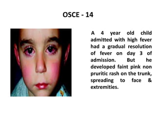 OSCE - 14
A 4 year old child
admitted with high fever
had a gradual resolution
of fever on day 3 of
admission. But he
developed faint pink non
pruritic rash on the trunk,
spreading to face &
extremities.
 