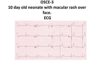 OSCE-3
10 day old neonate with macular rash over
face.
ECG
 