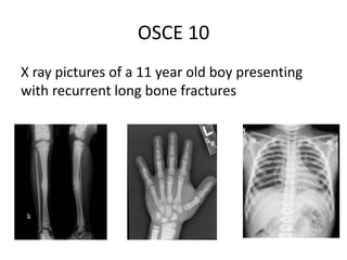 OSCE 10
X ray pictures of a 11 year old boy presenting
with recurrent long bone fractures
 