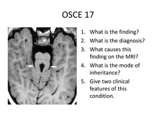 OSCE 17
1. What is the finding?
2. What is the diagnosis?
3. What causes this
finding on the MRI?
4. What is the mode of
inheritance?
5. Give two clinical
features of this
condition.
 