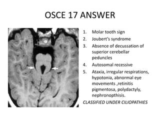 OSCE 17 ANSWER
1. Molar tooth sign
2. Joubert’s syndrome
3. Absence of decussation of
superior cerebellar
peduncles
4. Autosomal recessive
5. Ataxia, irregular respirations,
hypotonia, abnormal eye
movements ,retinitis
pigmentosa, polydactyly,
nephronopthisis.
CLASSIFIED UNDER CILIOPATHIES
 