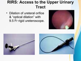 RIRS: Access to the Upper Urinary
Tract
• Dilation of ureteral orifice
& “optical dilation” with
9.5 Fr rigid ureteroscope.
 