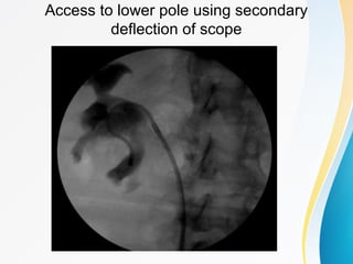Access to lower pole using secondary
deflection of scope
 
