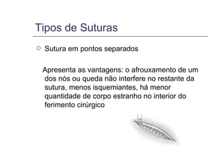 Tipos de Suturas Sutura em pontos separados Apresenta as vantagens: o afrouxamento de um dos nós ou queda não interfere no restante da sutura, menos isquemiantes, há menor quantidade de corpo estranho no interior do ferimento cirúrgico 
