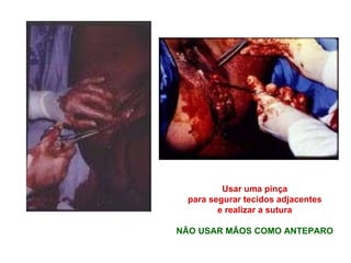 Usar uma pinça para segurar tecidos adjacentes  e realizar a sutura NÃO USAR MÃOS COMO ANTEPARO 