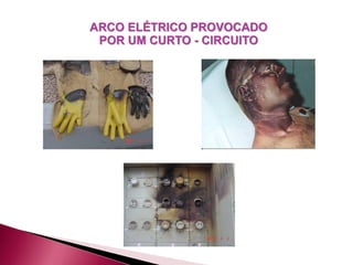ARCO ELÉTRICO PROVOCADO
POR UM CURTO - CIRCUITO
 