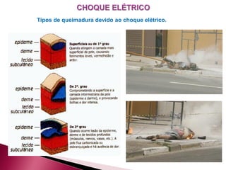 Tipos de queimadura devido ao choque elétrico.
 