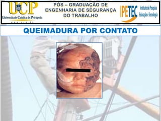 QUEIMADURA POR CONTATO
 