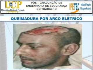 QUEIMADURA POR ARCO ELÉTRICO
 