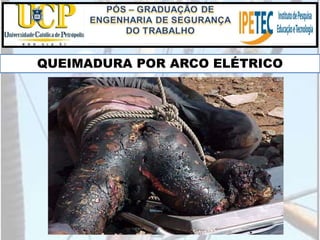 QUEIMADURA POR ARCO ELÉTRICO
 