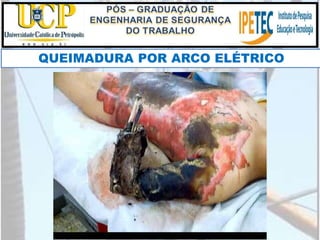 QUEIMADURA POR ARCO ELÉTRICO
 