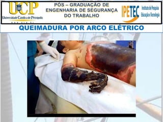QUEIMADURA POR ARCO ELÉTRICO
 