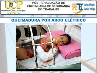QUEIMADURA POR ARCO ELÉTRICO
 