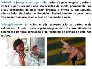 Geladura (congelamento parcial): partes da pele congelam, sofrem
lesões superficiais mas não são lesadas de modo permanente. As
áreas congeladas da pele ficam brancas e firmes e, em seguida,
edemaciadas (inchadas) e doloridas. Posteriormente, a pele pode
descamar, como ocorre nos casos de queimadura solar.
Congelamento: as mãos e pés expostos são as partes mais
vulneráveis. A lesão causada pelo congelamento é conseqüência da
diminuição do fluxo sangüíneo e da formação de cristais de gelo nos
tecidos.
 