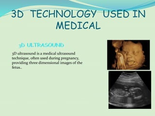 3D TECHNOLOGY USED IN
MEDICAL
3D ultrasound is a medical ultrasound
technique, often used during pregnancy,
providing three dimensional images of the
fetus..
 