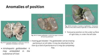 Floating gall bladder: The gallbladder will be lined by
peritoneum on all sides. It may be attached to the
liver by a fold of peritoneum or it may be completely
free.
Intrahepatic gallbladder: it
may embedded in the
substance of liver.
Anomalies of position
Transverse position on the under surface
of right lobe, or under the left lobe.
 