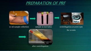 Prf File Platelet Rich Fibrin (PRF) | PPTX