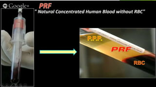 Clean Prf Platelet Rich Fibrin (PRF) | PPTX
