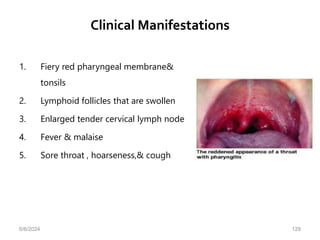 Clinical Manifestations
1. Fiery red pharyngeal membrane&
tonsils
2. Lymphoid follicles that are swollen
3. Enlarged tender cervical lymph node
4. Fever & malaise
5. Sore throat , hoarseness,& cough
6/6/2024 129
 