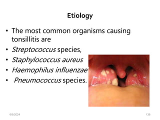 Etiology
• The most common organisms causing
tonsillitis are
• Streptococcus species,
• Staphylococcus aureus
• Haemophilus influenzae
• Pneumococcus species.
6/6/2024 138
 