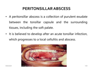 PERITONSILLAR ABSCESS
• A peritonsillar abscess is a collection of purulent exudate
between the tonsillar capsule and the surrounding
tissues, including the soft palate.
• It is believed to develop after an acute tonsillar infection,
which progresses to a local cellulitis and abscess.
6/6/2024 144
 