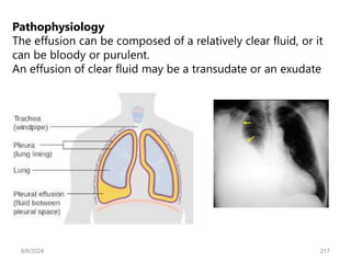 Pathophysiology
The effusion can be composed of a relatively clear fluid, or it
can be bloody or purulent.
An effusion of clear fluid may be a transudate or an exudate
6/6/2024 217
 