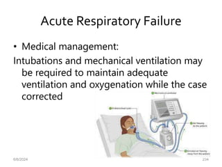 Acute Respiratory Failure
• Medical management:
Intubations and mechanical ventilation may
be required to maintain adequate
ventilation and oxygenation while the case
corrected
6/6/2024 234
 