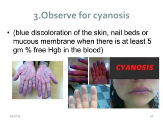 3.Observe for cyanosis
64
• (blue discoloration of the skin, nail beds or
mucous membrane when there is at least 5
gm % free Hgb in the blood)
6/6/2024
 