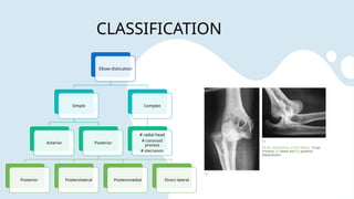Coronoid Classification ELBOW TRAUMA Injuries with recent evidences | PPTX