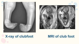 Club foot in Child | PPTX