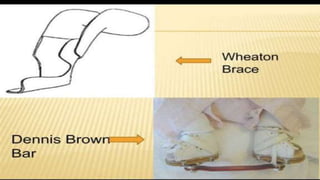 Club foot in Child | PPTX