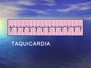 TAQUICARDIA
 