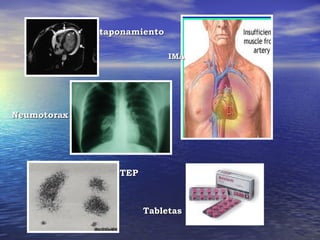 taponamiento

                            IMA




Neumotorax




                TEP



                      Tabletas
 