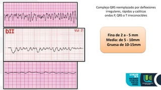 Complejo QRS reemplazado por deflexiones
irregulares, rápidas y caóticas
ondas P, QRS o T irreconocibles
Fina de 2 a - 5 mm
Media: de 5 - 10mm
Gruesa de 10-15mm
 