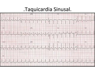 Ritmo sinusal- electrocardiografia i.ppt