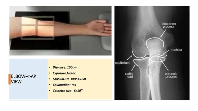 Radiographic positioning of Upper limb (ELBOW & HUMERUS) | PPTX | Death ...
