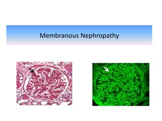 Membranous Nephropathy
 