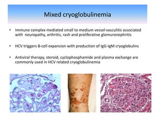 Mixed cryoglobulinemia
• Immune complex mediated small to medium vessel vasculitis associated
with neuropathy, arthritis, rash and proliferative glomuronephritis
• HCV triggers B-cell expansion with production of IgG-IgM cryoglobulins
• Antiviral therapy, steroid, cyclophosphamide and plasma exchange are
commonly used in HCV related cryoglobulinemia
 