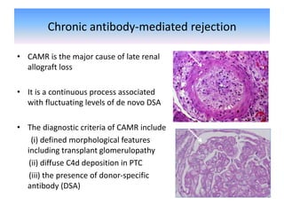 Chronic antibody-mediated rejection
• CAMR is the major cause of late renal
allograft loss
• It is a continuous process associated
with fluctuating levels of de novo DSA
• The diagnostic criteria of CAMR include
(i) defined morphological features
including transplant glomerulopathy
(ii) diffuse C4d deposition in PTC
(iii) the presence of donor-specific
antibody (DSA)
 