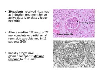 • 20 patients received rituximab
as induction treatment for an
active class IV or class V lupus
nephritis
• After a median follow-up of 22
mo, complete or partial renal
remission was obtained in 12
patients (60%)
• Rapidly progressive
glomerulonephritis did not
respond to rituximab
 