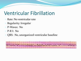 Ventricular Fibrillation
 Rate: No ventricular rate
 Regularity: Irregular
 P-Waves: No
 P-R I: No
 QRS: No, unorganized ventricular baseline
 
