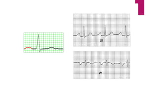 ATRIAL FIBRILLATION AND ATRIAL FLUTTER
 Treated with Ventricular Rate Control and/or Synchronized Cardioversion
 Atrial ...