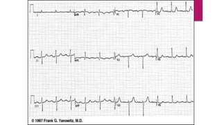 MULTIFOCAL ATRIAL TACHYCARDIA
 An irregular rhythm resulting from at least three different atrial foci competing to
pace ...